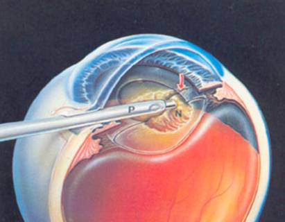 Cataracts 5