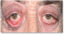 Ectropion 1