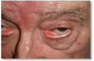 Ectropion 2