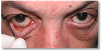 Ectropion 4