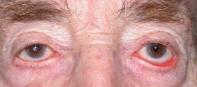 Ectropion 10