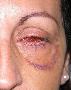 Enucleation Evisceration  Exenteration 13
