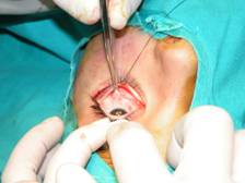 Orbital fractures 3