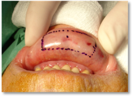 Eyelash malposition4