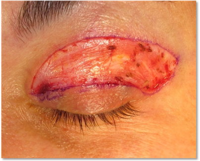 Blepharoplasty 5