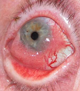 Conjunctival tumors 9