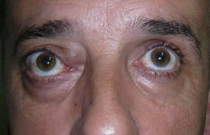 Orbital tumours 11