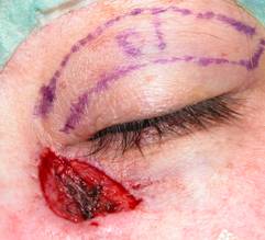 Eyelid Tumours 9