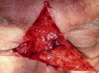 Eyelid Tumours 14