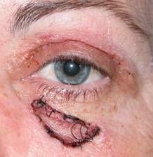 Eyelid Tumours 25
