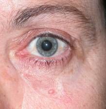 Eyelid Tumours 26