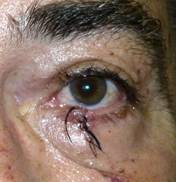 Eyelid Tumours 30
