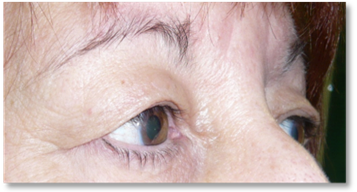 Dermatocalasia 2