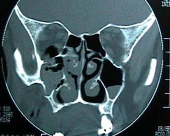 Fracturas orbitarias 1