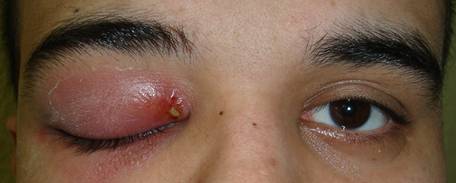 Inflamaciones Orbitarias 1