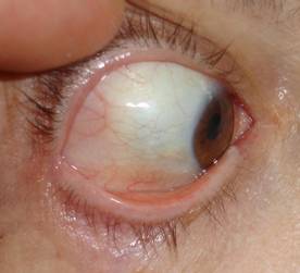 Inflamaciones Orbitarias 14