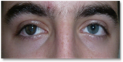 Ptosis palpebral 4