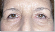 Ptosis palpebral 7