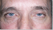 Ptosis palpebral 12