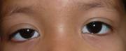 Ptosis palpebral 15
