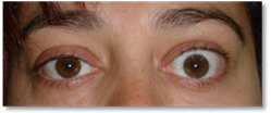 Retraccion palpebral 4