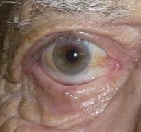 Retraccion palpebral 11