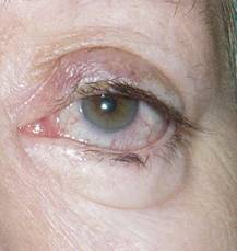 Retraccion palpebral 15