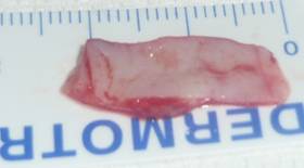 Retraccion palpebral 18
